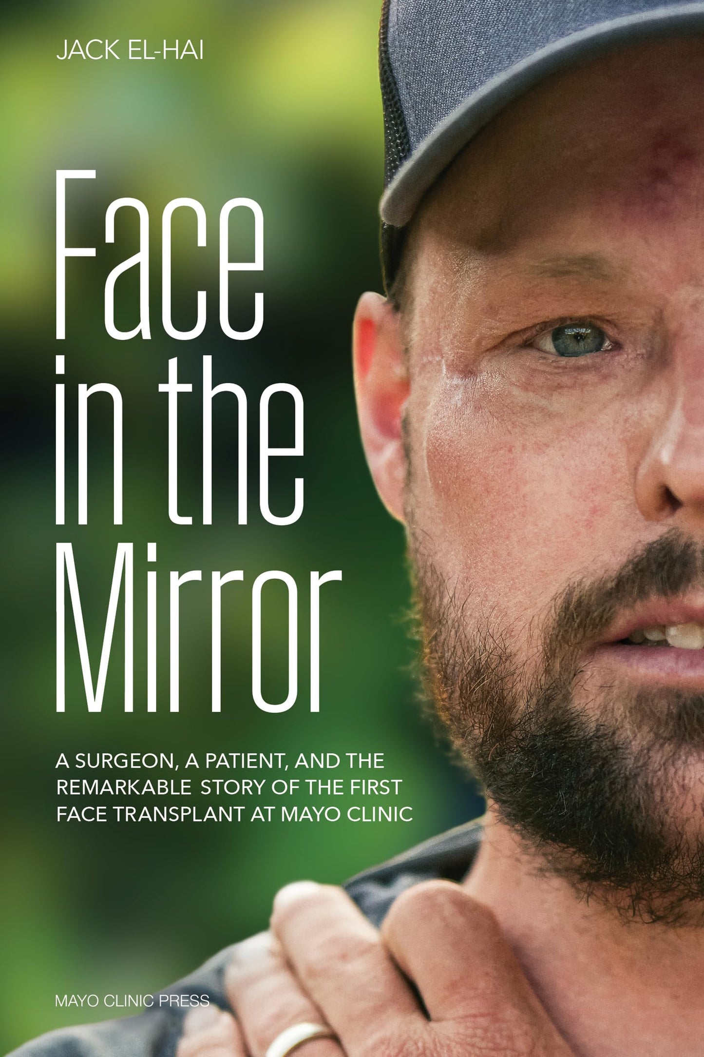 Face in the Mirror: A Surgeon, a Patient, and the Remarkable Story of the First Face Transplant at Mayo Clinic